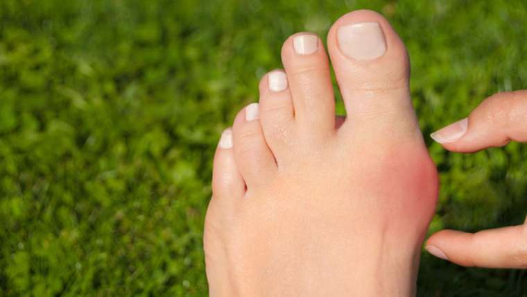 Halluks Valgus
