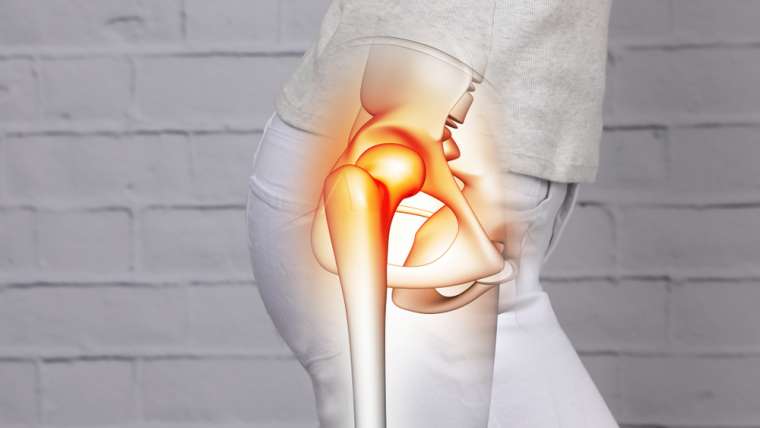 Kalça Kireçlenmesi (Kalça Osteoartriti)